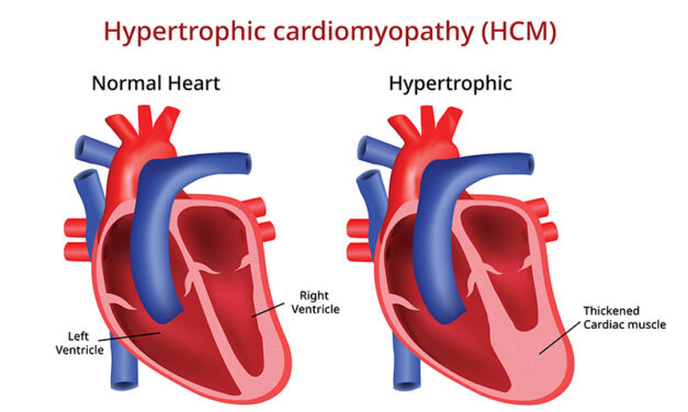Noi abordări ale cardiomiopatiei hipertrofice