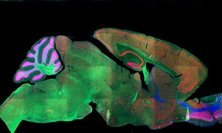 Niemann-Pick, o afecțiune neurologică progresivă care începe adesea în copilărie