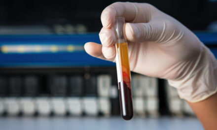 Un marker de sânge ar putea identifica pacienții cu risc crescut de boală a arterelor periferice