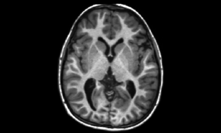 Un studiu nou leagă anxietatea și tulburarea de stres post-traumatic de creșterea mielinei în substanța cenușie a creierului
