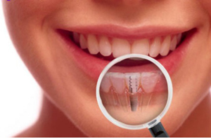 Unu din șase români care merg la stomatolog îşi pune cel puţin un implant dentar
