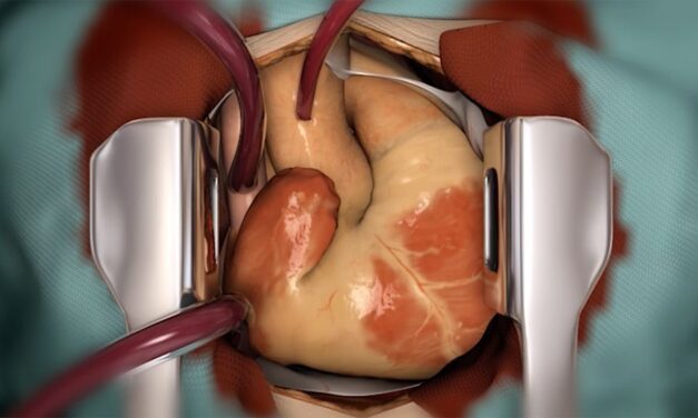 O nouă metodă de transplant ar putea extinde oferta de inimi provenite de la donatori