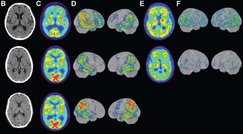 Oamenii de știință din Suedia au descoperit o formă rară și agresivă de Alzheimer cu debut precoce