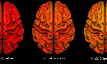 Modificările creierului în urma leziunilor cerebrale traumatice sunt similare cu boala Alzheimer