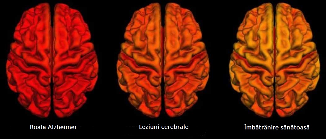Modificările creierului în urma leziunilor cerebrale traumatice sunt similare cu boala Alzheimer