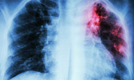 Campania de depistare precoce a tuberculozei continuă în Ilfov